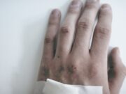 Vaiolo delle scimmie, l’Oms lancia l’allerta globale: rischio alto in Europa vaiolo-delle-scimmie-oms-lancia-lallerta-globale-rischio-alto-in-europa