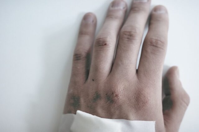 vaiolo-delle-scimmie-oms-lancia-lallerta-globale-rischio-alto-in-europa